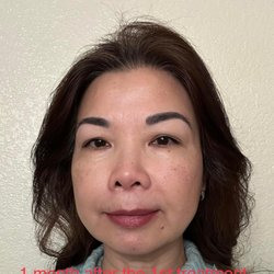 A+ Vision Optometry - 1 month after 1st Tempsure treatment