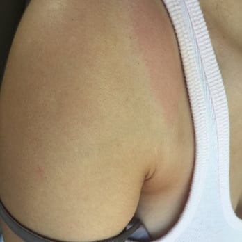 Escape Day Spa - Chemical burns because I listened to employees advice about fixing my airbrush tan. She recommended a magic eraser. - Day Spas Near Me - Birmingham, Alabama