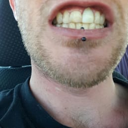 Elloway's assymetrical hack work. That crown is twice as tall as it's companion incisor. Elloway's assymetrical hack work. That crown is twice as tall as it's companion incisor.