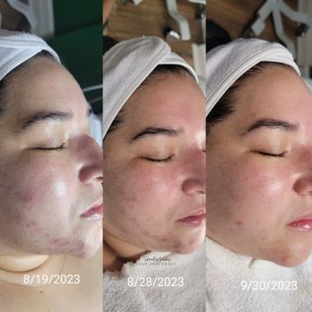 Skin By Gabby - The BioRePeel Treatment - Skin Care Near Me - Upland, California Skin By Gabby - The BioRePeel Treatment - Skin Care Near Me - Upland, California