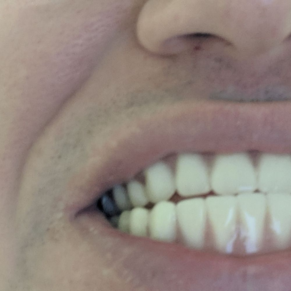Aspen Dental - Mattoon, IL - Poor alignment of dentures due to negligence and malpractice - Oral Surgeons Near Me - Mattoon, Illinois