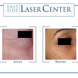 East Side Laser Center - Laser hair removal tattoo removal traumatic scar removal acne scar removal laser skin rejuvenation fraxel laser scar removal ...