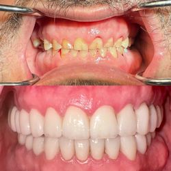 Gauri Madaan - Santa Teresa Family Dental - Look at my before and after. I am still amazed.
