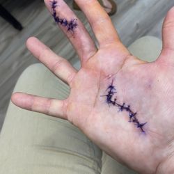 James R McClurg, MD - Where the tendon was put second surgery, and stitches were removed