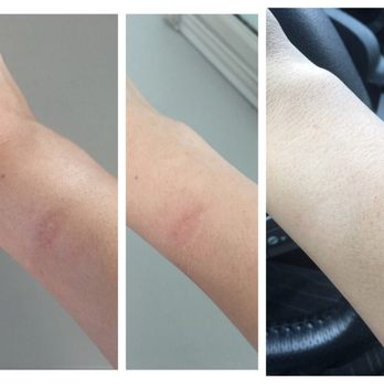 L'Or Cosmétique - Hyperpigmentation removal - Permanent Makeup Near Me - Redwood City, California L'Or Cosmétique - Hyperpigmentation removal - Permanent Makeup Near Me - Redwood City, California