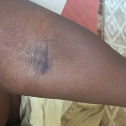 Bruise I got from get blood drawn, (never got a bruise before any other time)