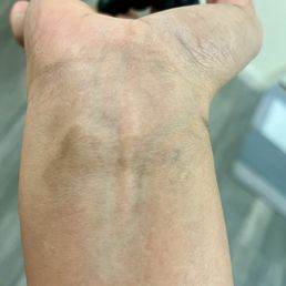 Tattoo removal (all black) after 6 sessions