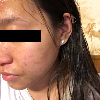 Agnes Skin Care - The night after my second appointment. Some pigmentation has already started to fade and slightly red but only because she did extraction. - Skin Care Near Me - Diamond Bar, California