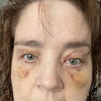 Hudson Face & Eye - Left eye I now have 3 eyelids, but she says that will heal - Ophthalmologists Near Me - New York, New York