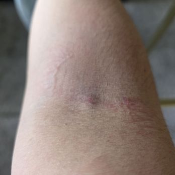 Quest Diagnostics - Middle raised sore is where she drew blood for a routine metabolic panel. - Laboratory Testing Near Me - Alameda, California