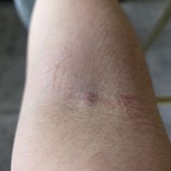 Quest Diagnostics - Middle raised sore is where she drew blood for a routine metabolic panel.