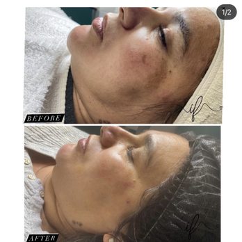Iona Esthetics - Melasma treatment. - Skin Care Near Me - Tampa, Florida Iona Esthetics - Melasma treatment. - Skin Care Near Me - Tampa, Florida