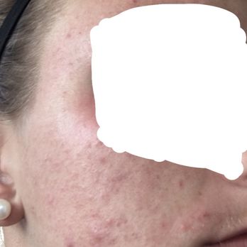 Remedies Skin & Laser - My skin before meeting Lori (and years after 3 rounds of Acutane) - Medical Spas Near Me - Mclean, Virginia Remedies Skin & Laser - My skin before meeting Lori (and years after 3 rounds of Acutane) - Medical Spas Near Me - Mclean, Virginia