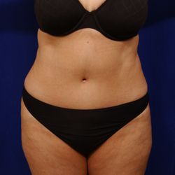 Moelleken Brent R, MD - Post- Tummy Tuck
