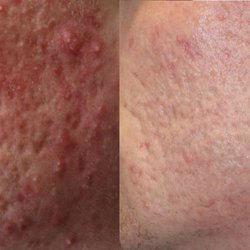 Michael Sarti, MD - Dr. Sarti is a true artist when it comes to repairing acne scars.