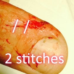 Concentra Urgent Care - We are looking at MY left thumb, after the accident today and where the stitches are.