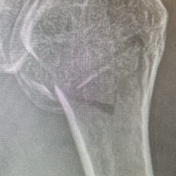 Southeast Orthopedic Specialists - Humeral Head multiple fractures