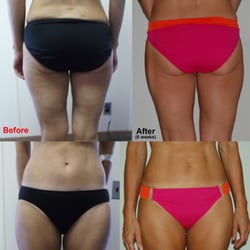 Before and after electro therapy