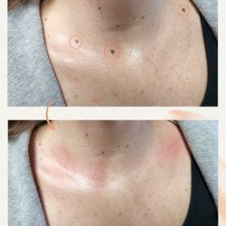 Plush Derma - Before and After
