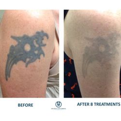 Removery Tattoo Removal & Fading