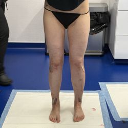 Artistic Lipo & Plastic Surgery - Post op day 1
