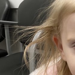 Hammond NorthShore Health Center - All the surgical glue in her hair