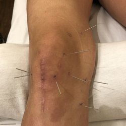 Oahu Central Earth Acupuncture & Chinese Medicine Clinic - Acupuncture & needles