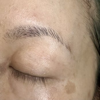 Starlit Aesthetics - My burned eyebrow and side hair never fully recovered from the botched M22 session, even 6 months later. - Medical Spas Near Me - West Covina, California Starlit Aesthetics - My burned eyebrow and side hair never fully recovered from the botched M22 session, even 6 months later. - Medical Spas Near Me - West Covina, California