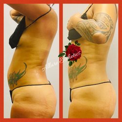 Allure Esthetics - Body Contouring treatment. Non-invasive lipo and Cavitation (fat reduction)