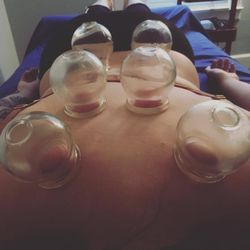Araya Acupuncture - Cupping is another modality that can be combined with acupuncture to help with painful conditions.