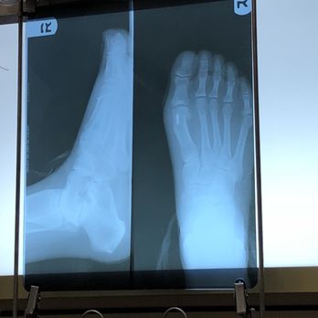 Matthew M Do, DPM - Right foot 7 weeks PO - Podiatrists Near Me Matthew M Do, DPM - Right foot 7 weeks PO - Podiatrists Near Me