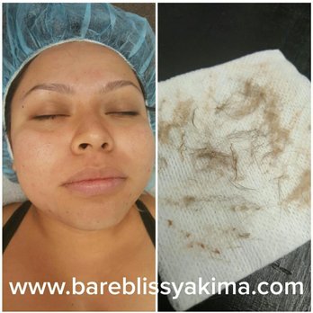 Bare Bliss - Velis hair and buil up from my pores removed during the dermaplaning service - Waxing Near Me - Yakima, Washington Bare Bliss - Velis hair and buil up from my pores removed during the dermaplaning service - Waxing Near Me - Yakima, Washington