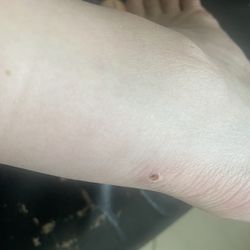 All Shoes $10.88 - Bruise caused by sneakers