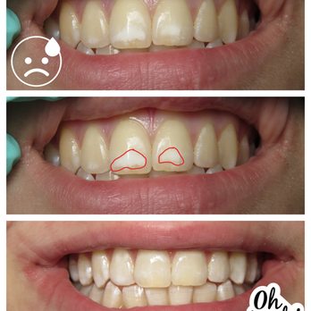 Serenity Smiles - This 16yo hated the white spots on her front teeth. We gave her a conservative solution that avoided bleaching and cutting teeth! :) - Cosmetic Dentists Near Me - Miramar Beach, Florida Serenity Smiles - This 16yo hated the white spots on her front teeth. We gave her a conservative solution that avoided bleaching and cutting teeth! :) - Cosmetic Dentists Near Me - Miramar Beach, Florida
