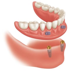 Dentures & Dental Services - Don't think you can afford implants? Think again. Call today to find out if you're a candidate at 210-599-8700.