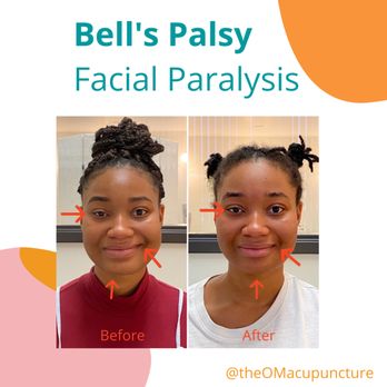 The OM Acupuncture Wellness - Bell's Palsy / Facial Paralysis? - Acupuncture Near Me - San Diego, California The OM Acupuncture Wellness - Bell's Palsy / Facial Paralysis? - Acupuncture Near Me - San Diego, California