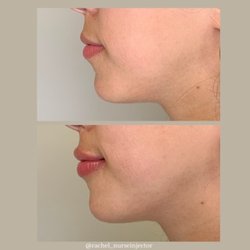 Illuminate Plastic Surgery - Lip filler results by Rachel Pavone, RN