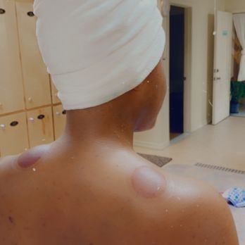 Loess Spa - Cupping on my shoulders. - Reflexology Near Me - Honolulu, Hawaii