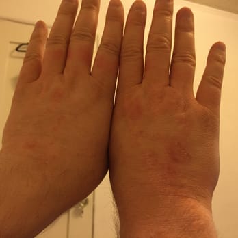 Robinhood Resort - Crazy scabies rash after my stay at Robinhood: basically don't stay here!!!! - Big Bear Lake, CA