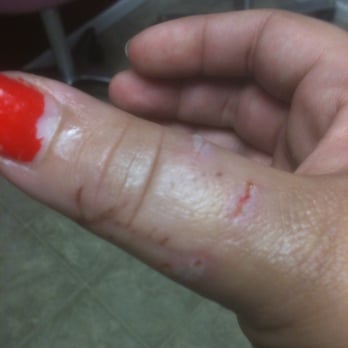 Urgent Care - Cat bite on second visit after unwrapping the gauze. Ouch! - Urgent Care Near Me - Big Bear Lake, California Urgent Care - Cat bite on second visit after unwrapping the gauze. Ouch! - Urgent Care Near Me - Big Bear Lake, California