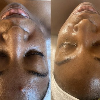 Skin by Ai - Skin transformation - Skin Care Near Me - Baldwin, New York Skin by Ai - Skin transformation - Skin Care Near Me - Baldwin, New York