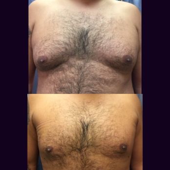 MD Cosmetic Clinic - Liposuction local Anesthesia in office out patient. - Medical Spas Near Me - Lake Forest, California MD Cosmetic Clinic - Liposuction local Anesthesia in office out patient. - Medical Spas Near Me - Lake Forest, California