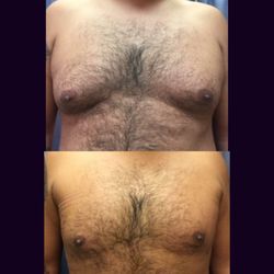 MD Cosmetic Clinic - Liposuction local Anesthesia in office out patient.