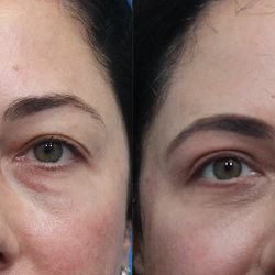 Justin Karlin, MD - Upper and lower blepharoplasty