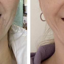 Denys Kovalchuk, DDS - Before and after with10 beautiful veneers ...used to be 8 and they were not great, Dr K designed and put in 10 perfect beauties