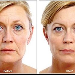 Exilis Therapy for Face and Body Sculpting
