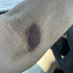 Sonora Quest Laboratories - Example of a blood draw from Kyla , Sonora quest she doesn't know her head from her ass
