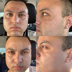 Vbrows Esthetics - TCA Peel!