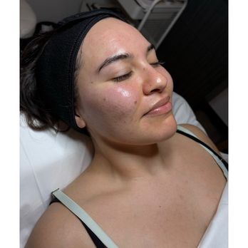 Optimize Skin - Dermaplaning Facial after glow - Estheticians Near Me - Orange, California Optimize Skin - Dermaplaning Facial after glow - Estheticians Near Me - Orange, California