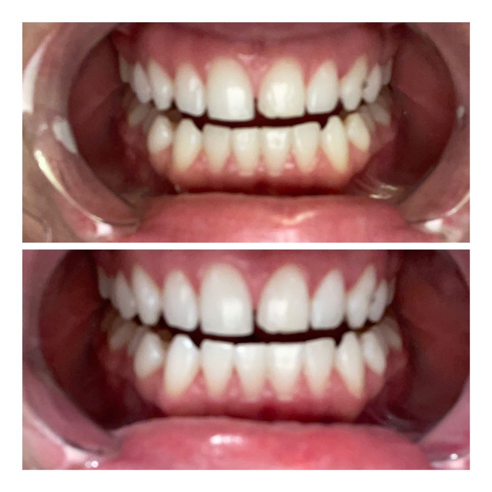 BODYSCULPTING BY MICHELLE Request an Appointment Teeth Whitening